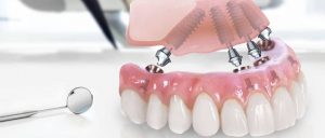 имплантация все на 4