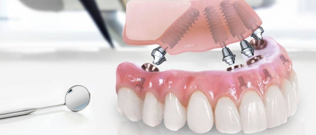 имплантация все на 4