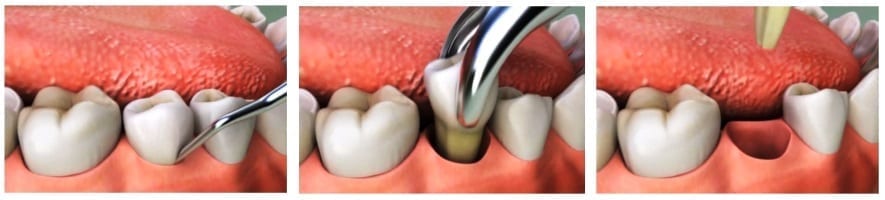 Удаление однокорневого зуба в Калуге