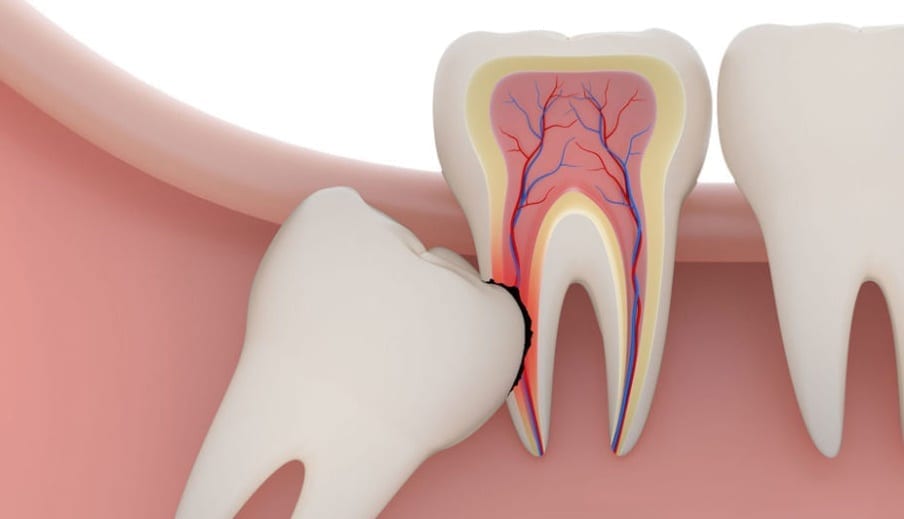 удаление ретинированного зуба в Калуге