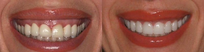 вестибулопластика в Калуге