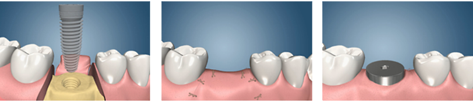 двухэтапная имплантация