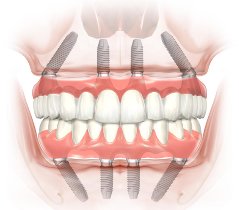 имлпантация все на 4