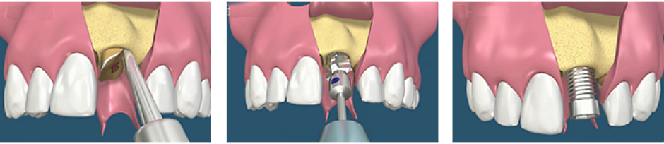 одномоментная имплантация