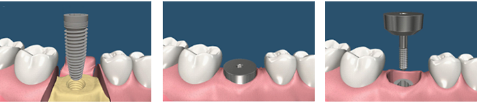 одноэтапная имплантация