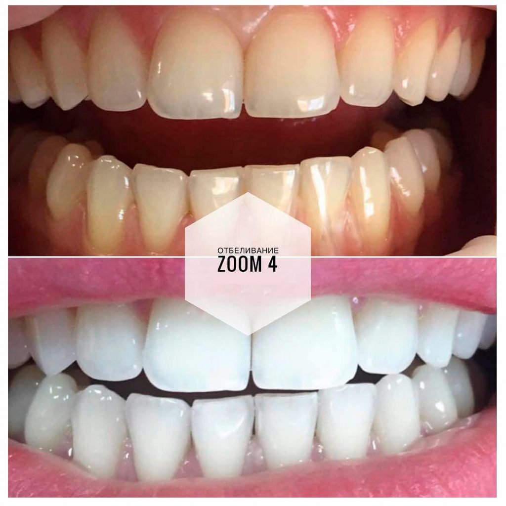 результаты отбеливания зубов Zoom 4