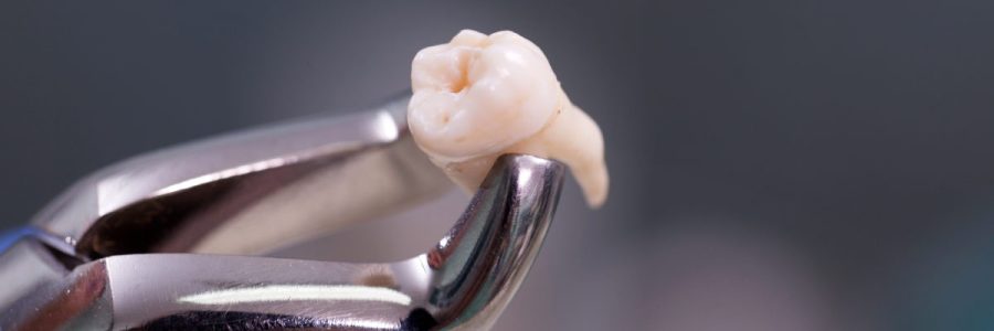 удаление зуба хирургия в клинике Эстетика Калуга