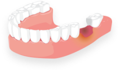 дефицит костной ткани